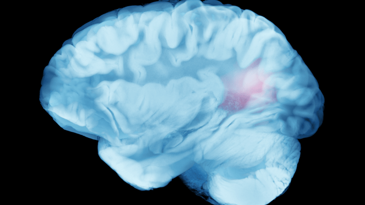 Hemorrhagic Stroke nclex prep