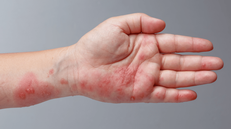 Herpes Zoster (Shingles) nclex review