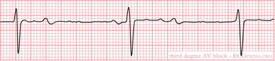 EKG Interpretation for Nurses | NURSING.com