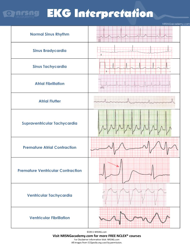 EKG Interpretation for Nurses | NURSING.com