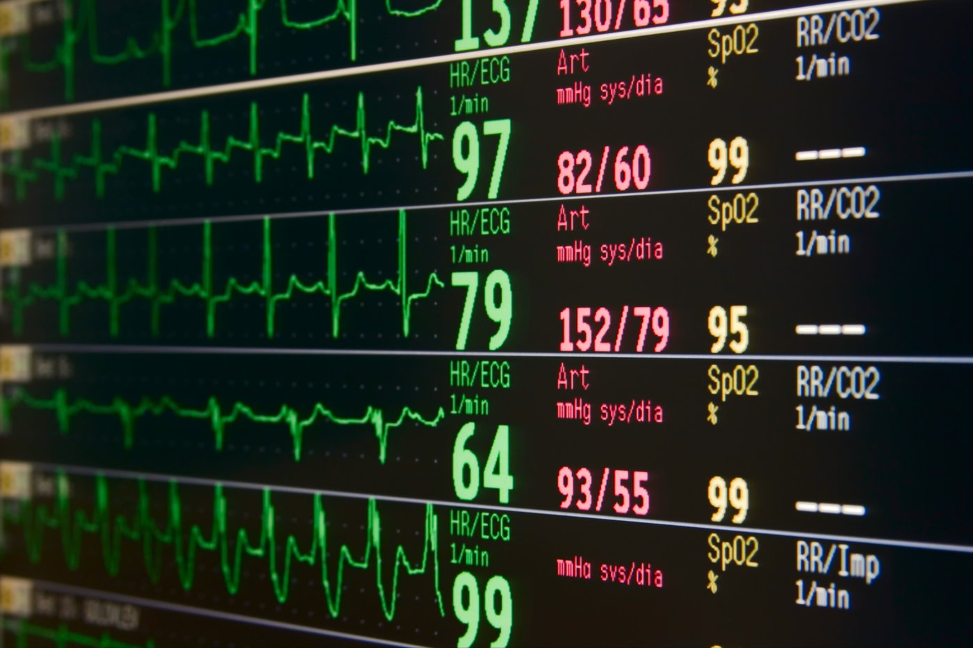 EKG Interpretation for Nurses | NURSING.com