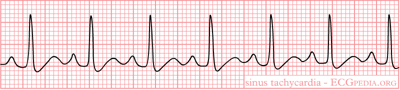 EKG Interpretation for Nurses | NURSING.com