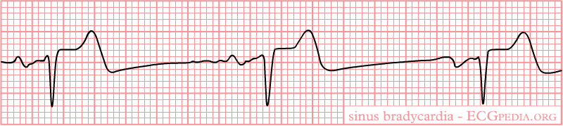 EKG Interpretation for Nurses | NURSING.com