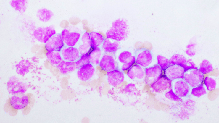 Leukemia nclex prep