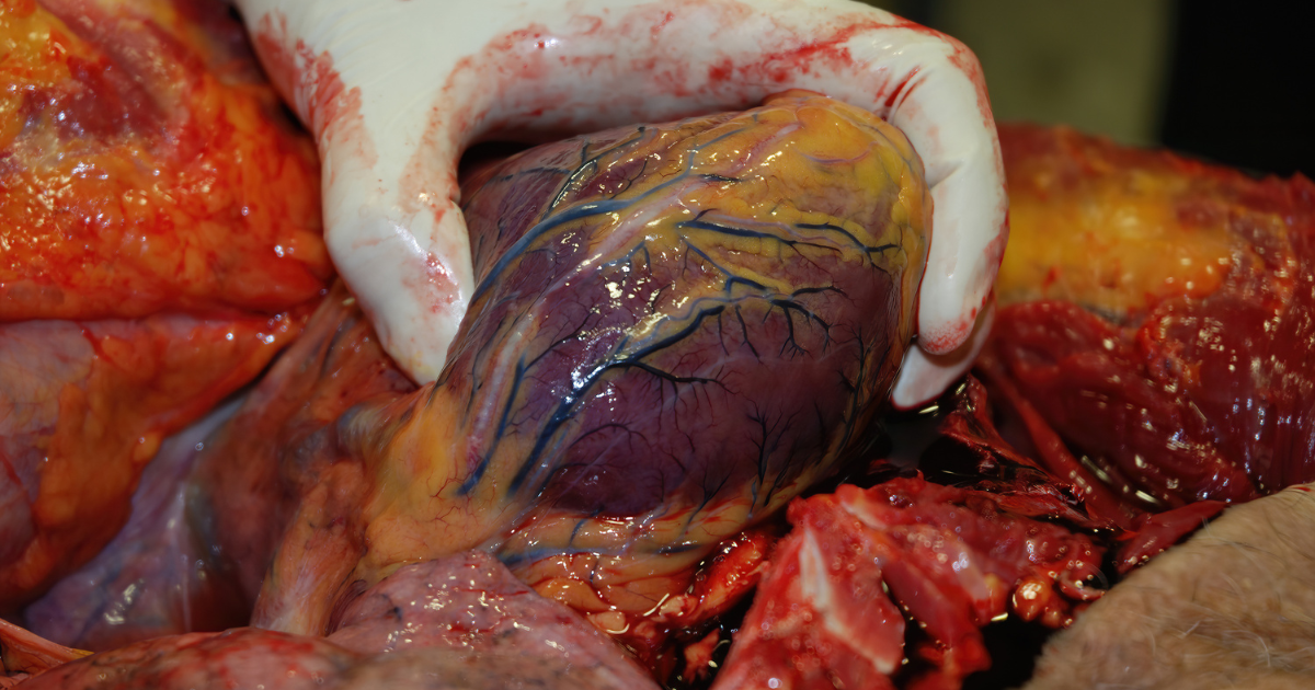 Myocardial infarction nclex overview