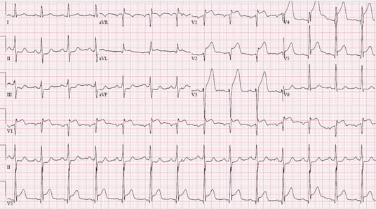 ST_elevation_myocardial_infarction_ECG_(cropped)