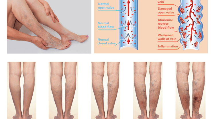 Thrombophlebitis nclex prep