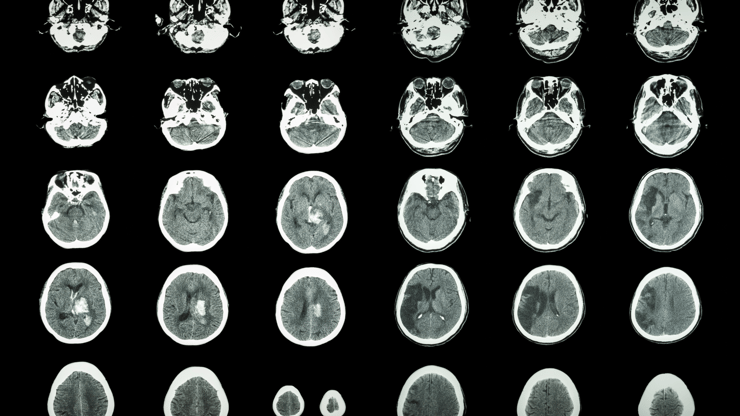 _Ischemic Stroke nclex prep