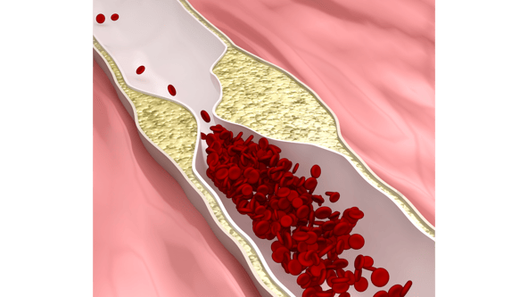 arterial plaque